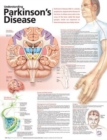 Understanding Parkinson's Disease Anatomical Chart - Book
