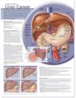 Understanding Liver Cancer Anatomical Chart - Book