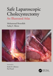 Safe Laparoscopic Cholecystectomy : An Illustrated Atlas