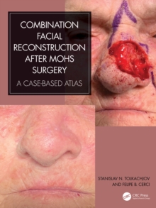 Combination Facial Reconstruction after Mohs Surgery : A Case Based Atlas