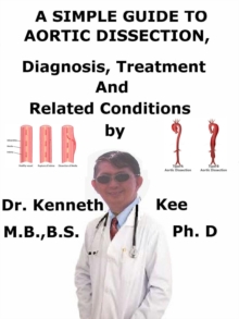 Simple Guide to Aortic Dissection, Diagnosis, Treatment and Related Conditions