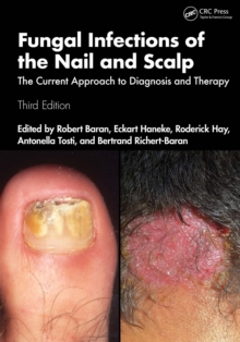 Fungal Infections of the Nail and Scalp : The Current Approach to Diagnosis and Therapy