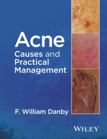 Acne : Causes and Practical Management