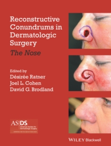 Reconstructive Conundrums in Dermatologic Surgery : The Nose