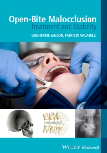 Open-Bite Malocclusion : Treatment and Stability, Paperback / softback Book Open-Bite Malocclusion : Treatment and Stability, Paperback / softback Book