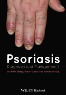 Psoriasis : Diagnosis and Management