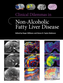 Clinical Dilemmas in Non-Alcoholic Fatty Liver Disease