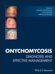 Onychomycosis : Diagnosis and Effective Management