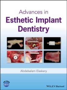 Advances in Esthetic Implant Dentistry