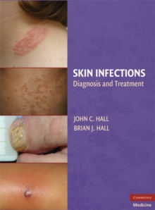 Skin Infections : Diagnosis and Treatment