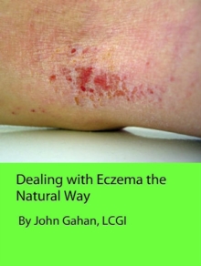 Dealing with Eczema the Natural Way