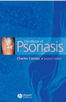 Handbook of Psoriasis