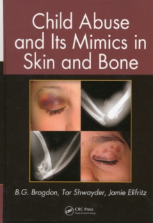 Child Abuse and its Mimics in Skin and Bone