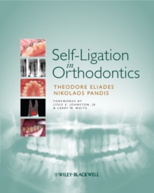 Self-Ligation in Orthodontics