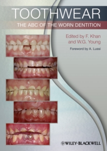 Toothwear : The ABC of the Worn Dentition