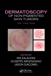 Dermatoscopy of Non-Pigmented Skin Tumors : Pink - Think - Blink