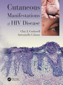 Cutaneous Manifestations of HIV Disease