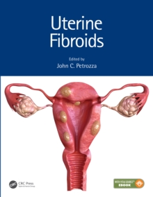 Uterine Fibroids