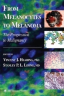 From Melanocytes to Melanoma : The Progression to Malignancy