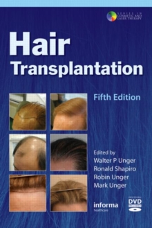 Hair Transplantation, Hardback Book Hair Transplantation, Hardback Book