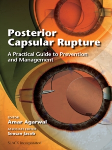 Posterior Capsular Rupture : A Practical Guide to Prevention and Management