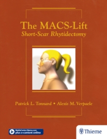 The MACS-Lift : Short-Scar Rhytidectomy