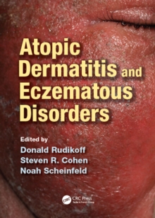 Atopic Dermatitis and Eczematous Disorders