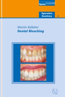 Dental Bleaching