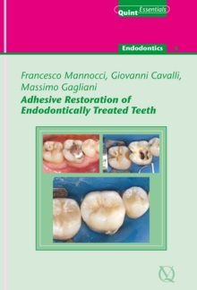 Adhesive Restoration of Endodontically Treated Teeth