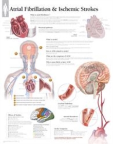 Atrial Fib & Ischemic Strokes Laminated Poster, Wallchart Book Atrial Fib & Ischemic Strokes Laminated Poster, Wallchart Book