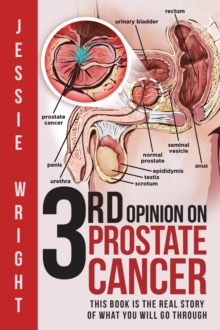 3rd Opinion on Prostate Cancer