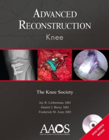 Advanced Reconstruction: Knee