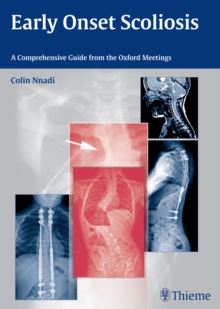 Early Onset Scoliosis : A Comprehensive Guide from the Oxford Meetings, Hardback Book Early Onset Scoliosis : A Comprehensive Guide from the Oxford Meetings, Hardback Book