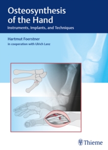 Osteosynthesis of the Hand : Instruments, Implants, and Techniques