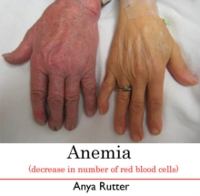 Anemia (decrease in number of red blood cells)