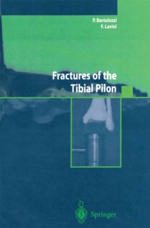 Fractures of the Tibial Pilon