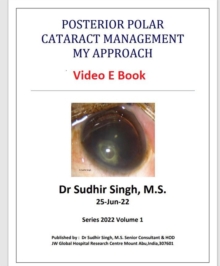 Posterior Polar Cataract Management: My Approach