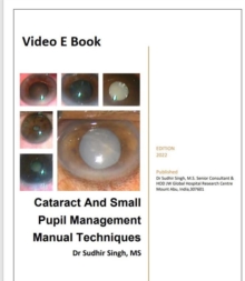 Cataract And Small Pupil Management Manual Techniques