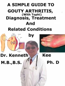 Simple Guide to Gouty Arthritis (With Tophi), Diagnosis, Treatment and Related Conditions