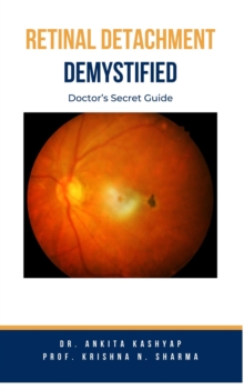 Retinal Detachment Demystified: Doctor's Secret Guide