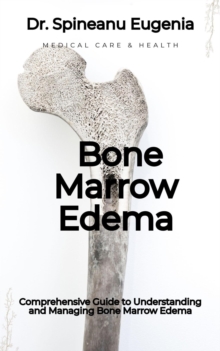 Comprehensive Guide To Understanding And Managing Bone Marrow Edema