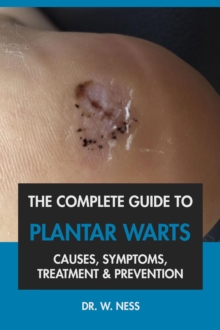 Complete Guide to Plantar Warts: Causes, Symptoms, Treatment & Prevention