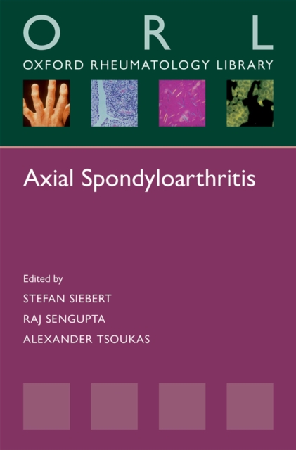 Axial Spondyloarthritis, PDF eBook