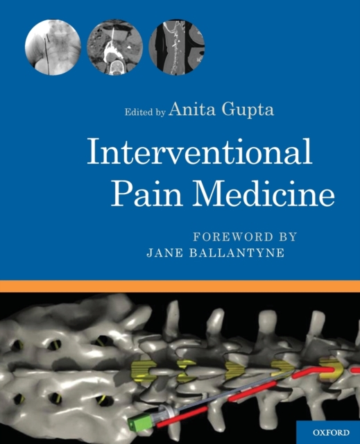 Interventional Pain Medicine, Spiral bound Book
