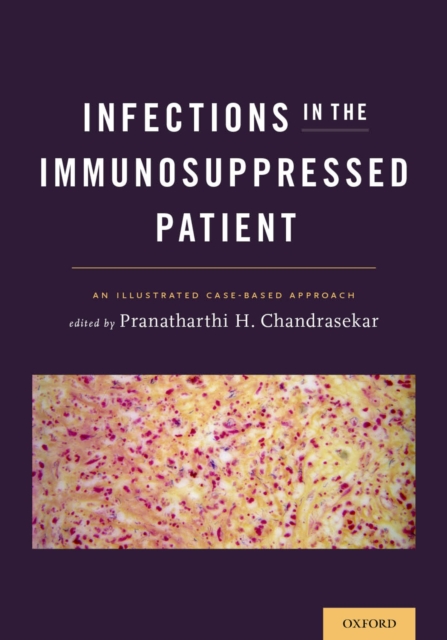 Infections in the Immunosuppressed Patient : An Illustrated Case-Based Approach, EPUB eBook