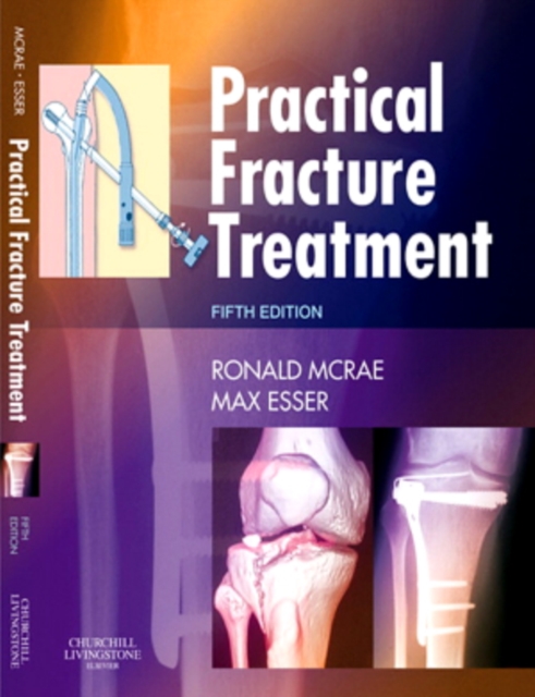 Practical Fracture Treatment E-Book : Practical Fracture Treatment E-Book, PDF eBook