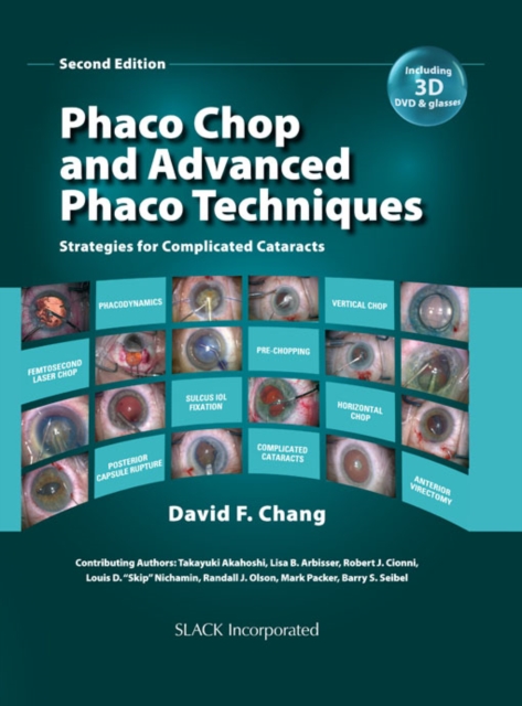 Phaco Chop and Advanced Phaco Techniques : Strategies for Complicated Cataracts, Second Edition, PDF eBook
