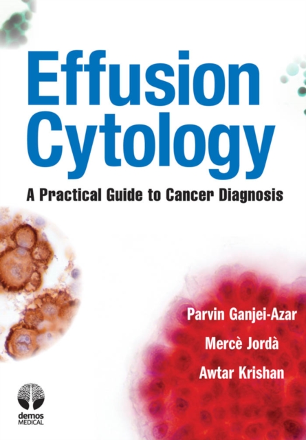 Effusion Cytology : A Practical Guide to Cancer Diagnosis, Paperback / softback Book