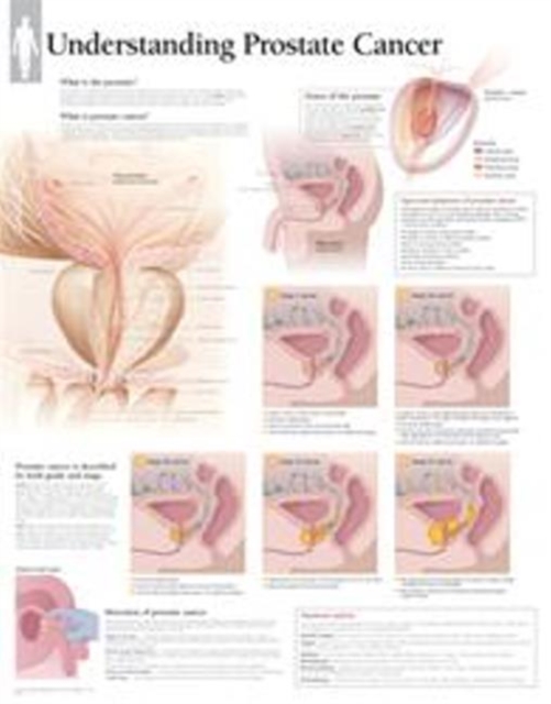 Understanding Prostate Cancer Paper Poster, Wallchart Book