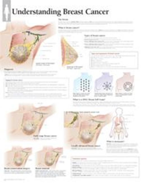 Understanding Breast Cancer Paper Poster, Wallchart Book